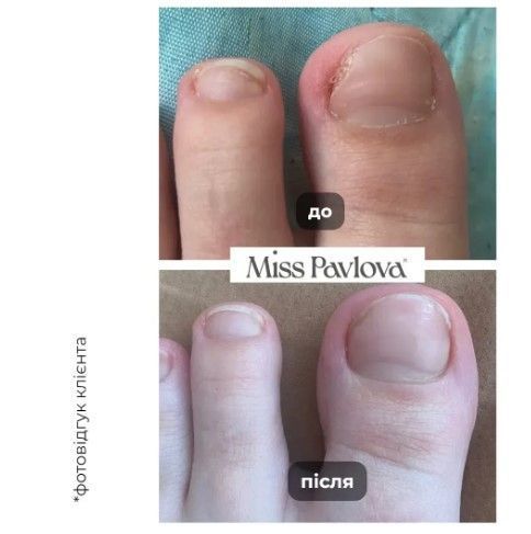Олія лікувальна від оніхолізіса Монарда 100% Miss Pavlova, 5 мл